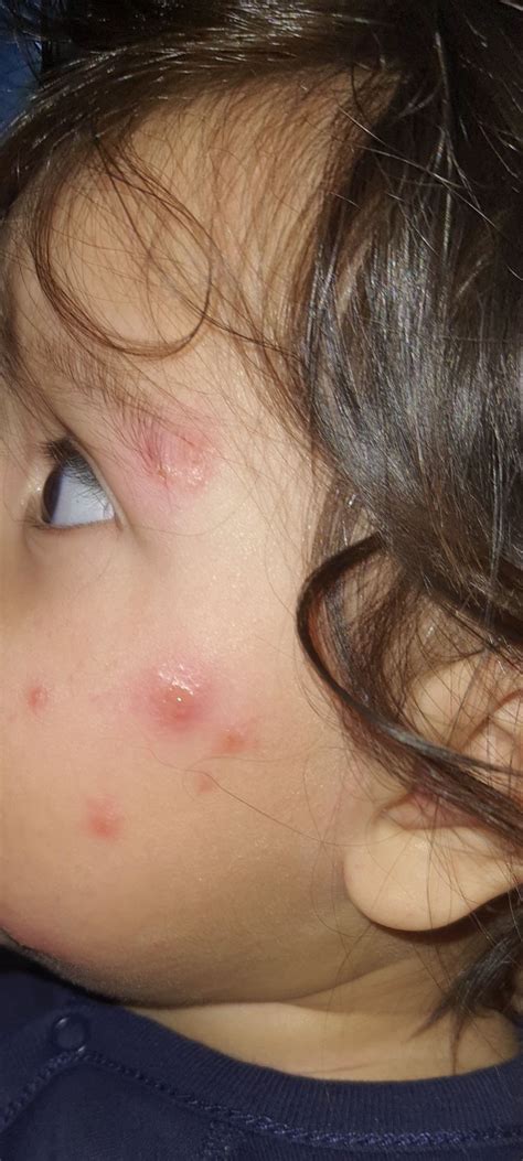 Staph Infection On Chin