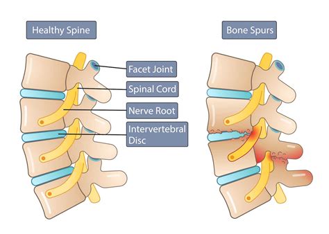 Uncovertebral Osteophytes