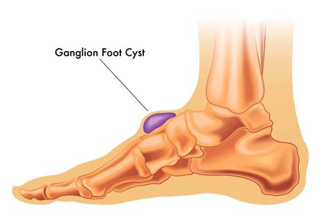 Ganglion Cyst Foot