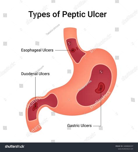 Peptic Ulcer Peptic Ulcer Stepwards