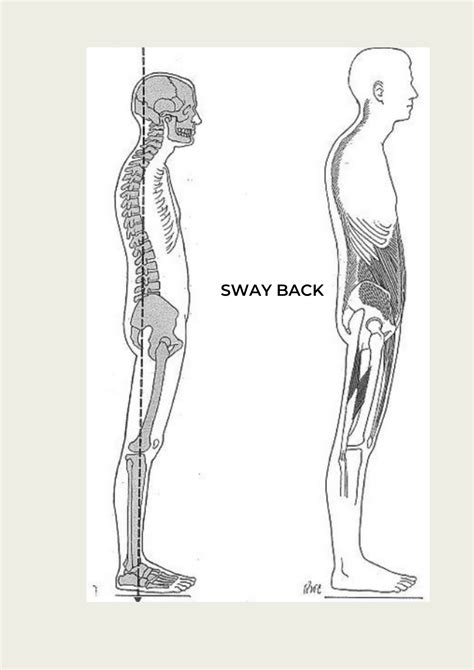 Sway Back Posture