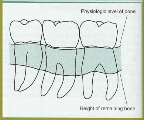 Image result for Two Walled Defect Perio
