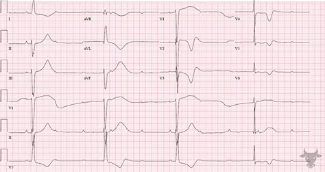 Ventricular Escape Rhythm