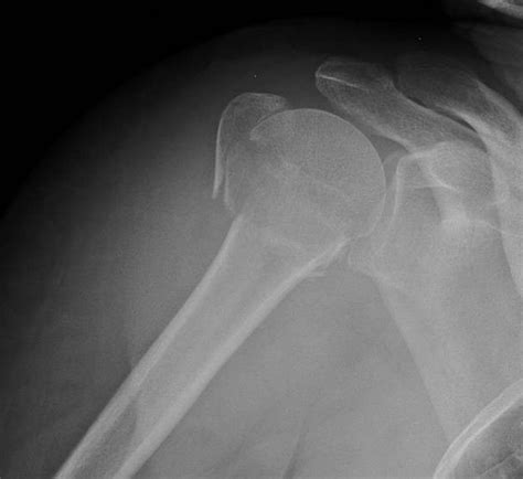 Proximal Humerus Fractures - Trauma - Orthobullets