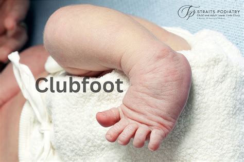 Clubfoot: Understand a Congenital Deformity - Straits Podiatry