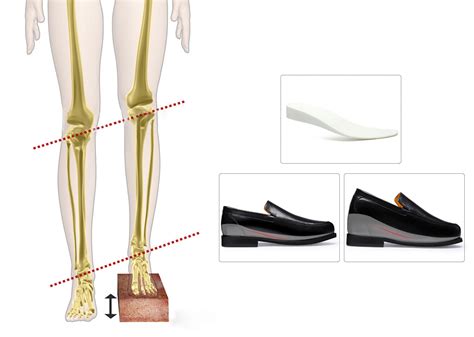 Measure Leg Length Discrepancy 的图像结果