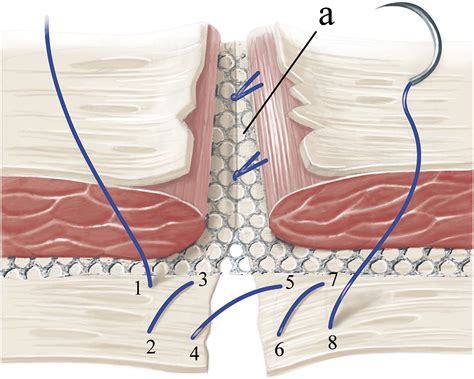 Inverting bilateral figure-of-eight suture of the rectus sheath after ...