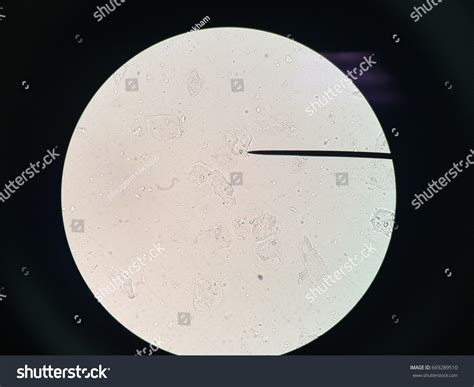 Mucus Threads In Urine Men