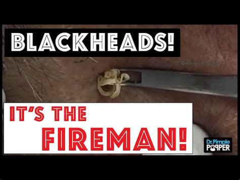 Image result for Exploding Zit Videos 2013