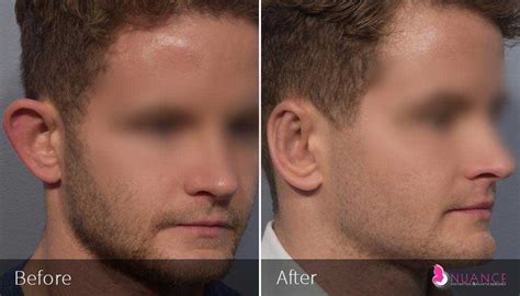 Image result for Ear Modification