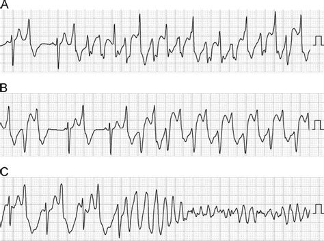 Ventricular tachycardia causes, symptoms, diagnosis, prognosis & treatment