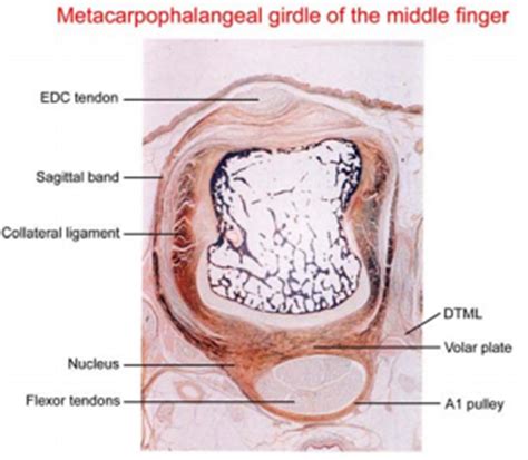 Sagittal Band Rupture - Hand - Orthobullets
