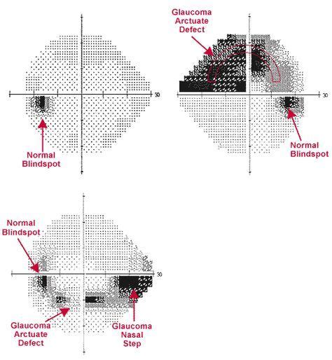 Image result for Visual Field Chart