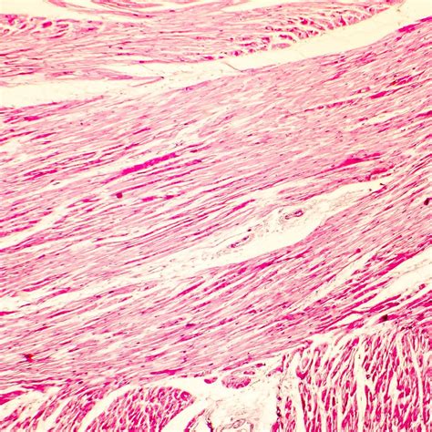 Erster direkter Therapieansatz bei HOCM - Kardiologie & Gefäßmedizin ...