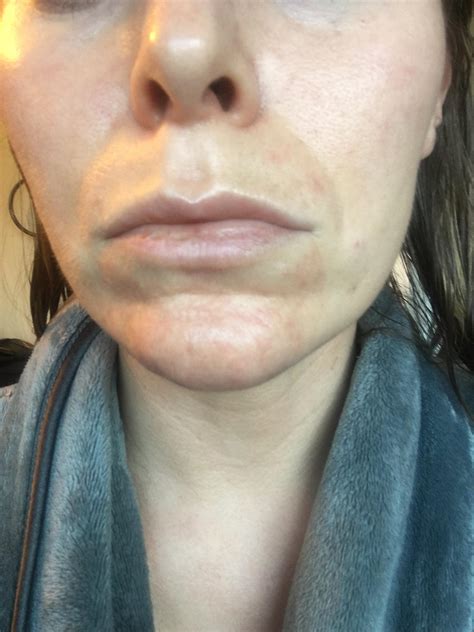 Cystic Acne Chin
