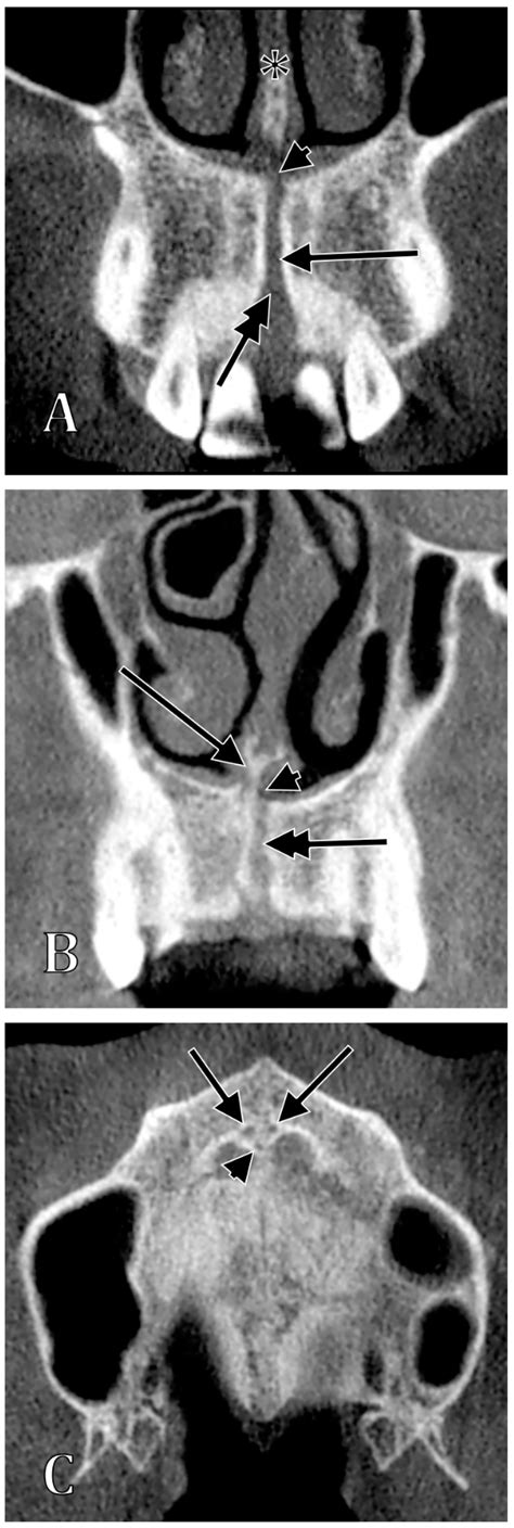 Detailed Morphology of the Incisive or Nasopalatine Canal