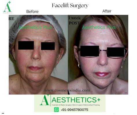 Facelift Surgery in Bangalore - Aesthetic Plus | Cosmetic surgeries ...