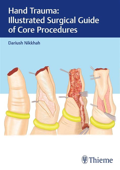 Hand Trauma: Illustrated Surgical Guide Of Core Procedures: 1/E - All ...