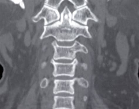 Cervical spine CT scan