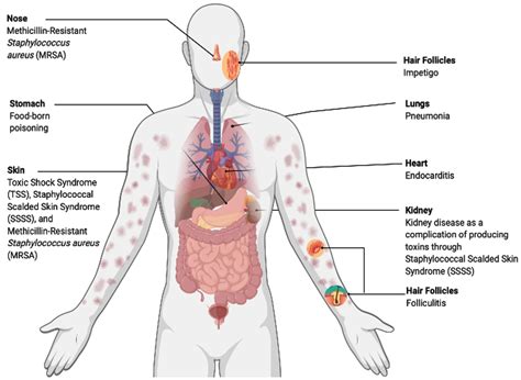 Staphylococcus aureus as Food-Borne Disease: An Ongoing Threat in ...