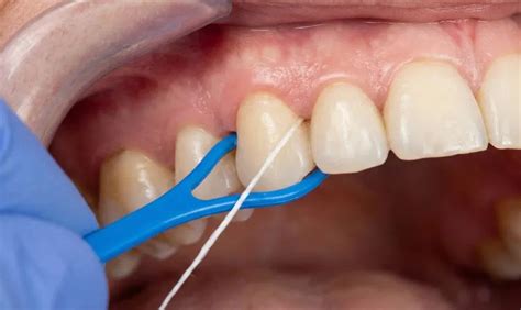 Image result for Using a Floss Threader