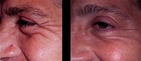 Image result for Botox Examples