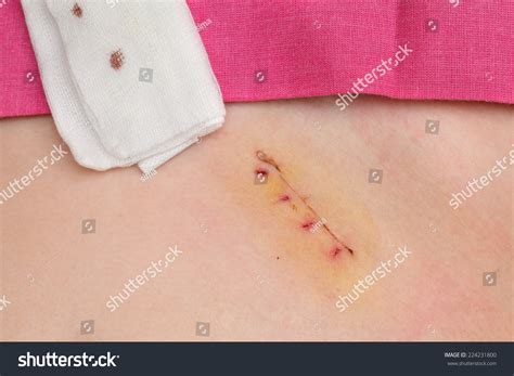 Image result for Appendix Surgery Scar