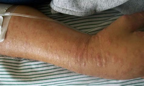 Asian patients with mycosis fungoides may have better survival outcomes ...