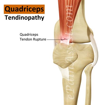 Quadriceps Tendinopathy|Signs|Symptoms|Treatment|Strengthening, Stretching Exercises