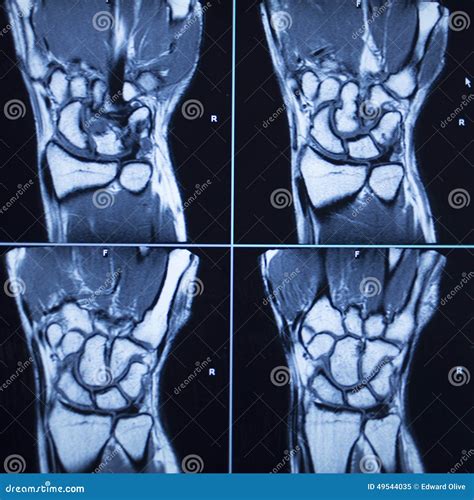MRI Scan Test Results Wrist Hand Injury Stock Image - Image of isolated ...