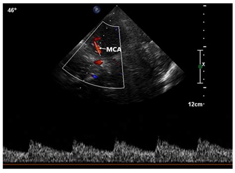 Right-to-Left Shunt Evaluation in Cardiac Patent Foramen Ovale Using Bubble Contrast ...