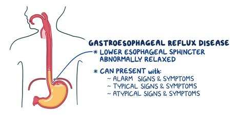 Gastroesophageal reflux disease: Clinical sciences - Osmosis Video Library