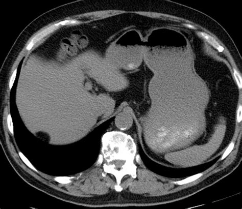Pseudolipoma of Glisson's Capsule - Body MR Radiology Case Studies ...