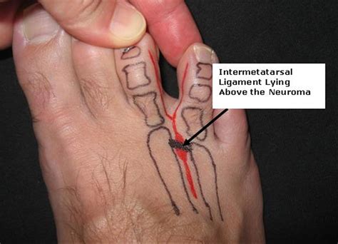 Metatarsalgie Links _ Morton-Neurom: Symptome, Ursachen & Behandlung – Gerd Breiter