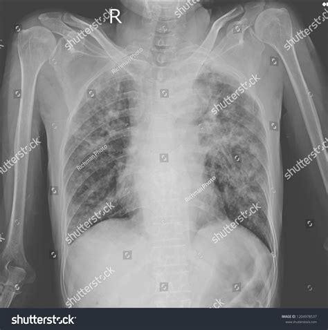 What Is An Infiltrate On A Chest X-Ray at Teresa Reid blog