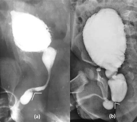 Are anterior urethral valve and anterior urethral diverticulum two separate entities: A ...