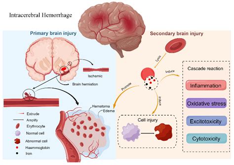 Intraparenchymal Hemorrhage Vs Subarachnoid Hemorrhage