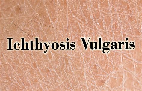 Ichthyosis Scoring System powerful tool to measure global ichthyosis ...