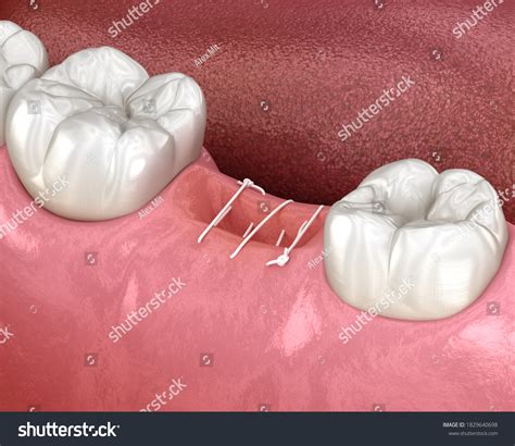 Image result for Stitches After Tooth Extraction