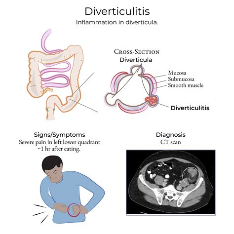 Clinical Pathology Glossary: Diverticulitis | ditki medical ...