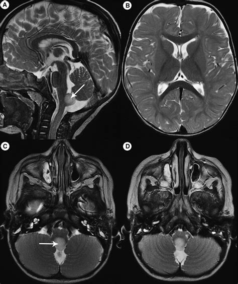 Area Postrema: Fetal Maturation, Tumors, Vomiting Center, Growth, Role in Neuromyelitis Optica ...