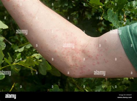 Image result for Moth Rash