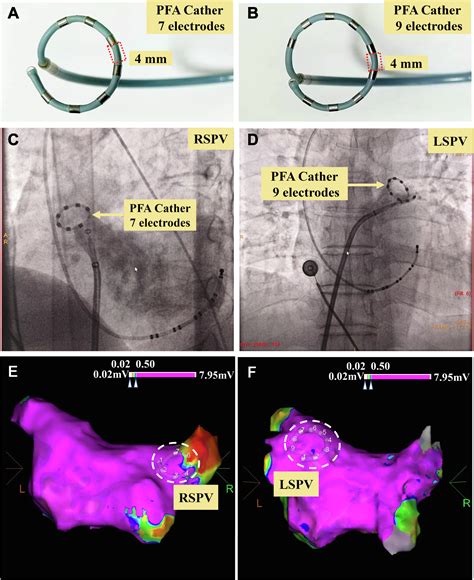 Effects of pulsed field ablation on autonomic nervous system in ...