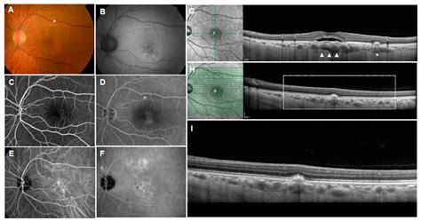 Early Stages of Age-Related Macular Degeneration: Racial/Ethnic ...