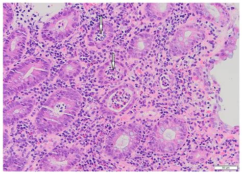 Fecal Microbiota Transplantation in Refractory Immune-Mediated Colitis ...