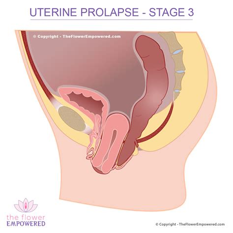 Urethra Prolapse