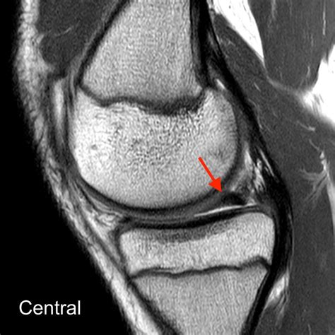 Does A Bucket Handle Meniscus Tear Need Surgery at James Gamble blog
