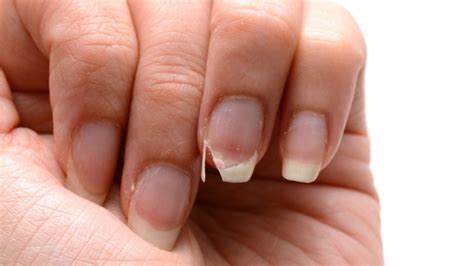 calcium deficiency nails