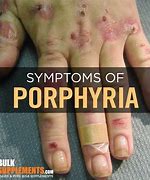 Image result for Porphyria