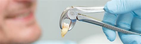 Difficult Tooth Root Extraction 的图像结果